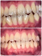 コントレール 歯ぁと(CONTRAIL)/歯の形に合わせて塗布したら
