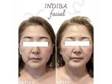 インディバ ベース(INDIBA BASE)の雰囲気（高周波が加齢の原因にアプローチ！ハリ艶UPで内側から元気な肌へ）