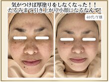 ポモナ 横浜馬車道店(Pomona)/シミやたるみにも効果テキメン！