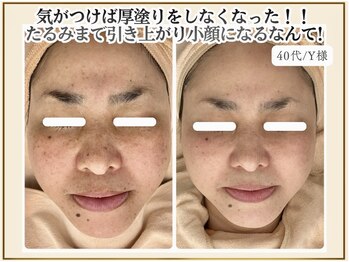 ポモナ 横浜馬車道店(Pomona)/シミやたるみにも効果テキメン！