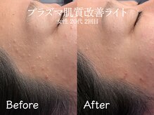 エイトスキン(8skin)/プラズマ肌質改善(毛穴洗浄付)