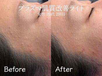 エイトスキン(8skin)/プラズマ肌質改善(毛穴洗浄付)