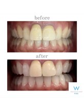 ホワイトニングショップ 町田店/【ビフォーアフター】10回