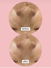 ディサイドロー(DECIDE L.A.W)/毛穴開き