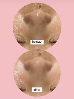 ディサイドロー(DECIDE L.A.W)/毛穴開き