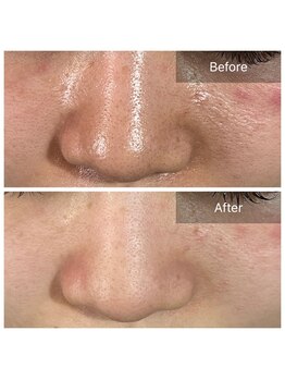 ピネ(pine)/Before After