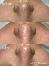 アース コアフュールボーテ 龍ヶ崎店(EARTH coiffure beaute)/最新型！顔殺菌毛穴洗浄