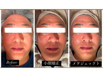 ベルカルポ(Bel Carp)/メタジェックトと小顔矯正