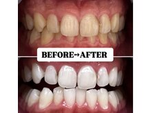 ホワイトニングサロン 豊中/Before&After美白ホワイトニング