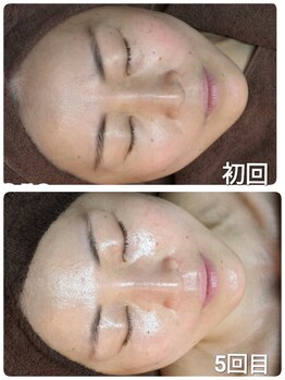 ウララ(ulala)/ララピール5回目