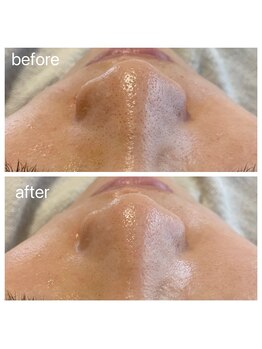 ビアス(VIAS)/フェイシャルワックス