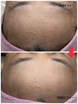 顔凛(カオリン)/気になっていたオデコのイボ改善