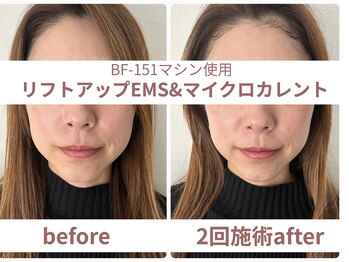 サボラミ(sabor A Mi)/リフトアップEMS 2回施術