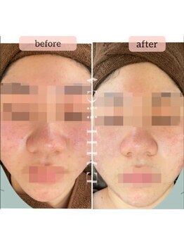 エミルカ 鹿児島店(EMILUCA)/ハーブピーリング 顔