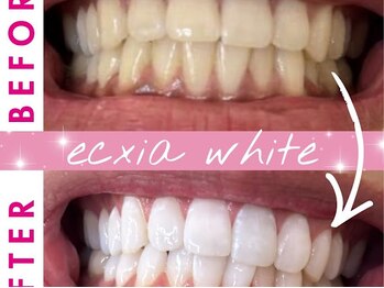 エクシアホワイトニング 姫路店/歯のビフォーアフター