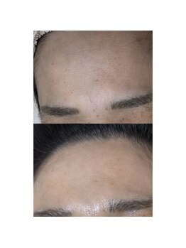 フル(FUL)/フェイシャルたるみシワケア