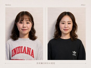 ハリスタ(HARISTA)/美容鍼+小顔矯正+LED美容
