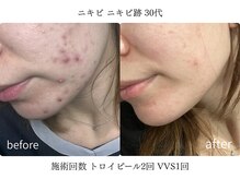 リエルエラン(Reelle Elan)の雰囲気(長年お悩みだった【ニキビ】を根本改善。目指せ!ニキビ肌卒業。)