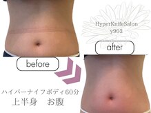 ワイキューマルサン(y903)/ハイパーナイフボディブライダル