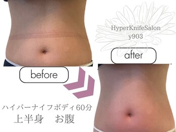 ワイキューマルサン(y903)/ハイパーナイフボディブライダル