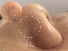 キャンディ 名古屋金山店(CANDi)/ハイドラピーリング黒ずみ毛穴◎