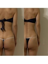 ミヨン(Miyong)/全身リフトアップ♪