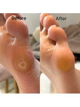 プラスワン(+1)/フット本物の足裏角質ケア魚の目