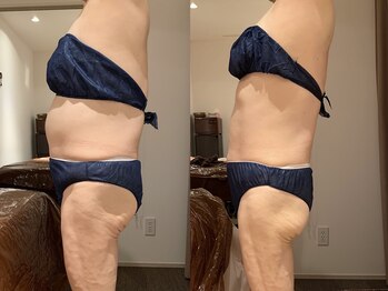 ビーグレイス(Vigrace)/ハイパーナイフEX/シェイプ8回