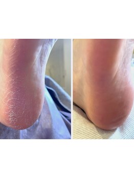 角質ケアができるサロン