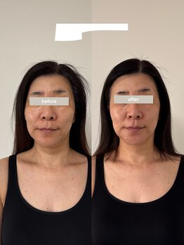 こつこつラボ サンイチマル オオル(310/OOL')/［50代/二重あご/歪み/たるみ］