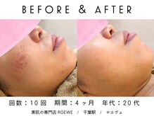 ロエヴェ(ROEWE)/ニキビ改善・毛穴ケア・肌質改善