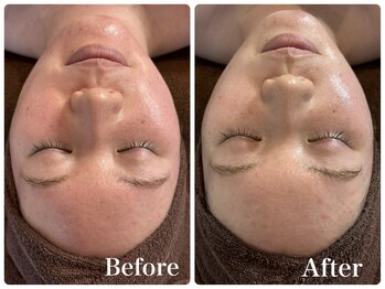 ハミングスキン(Humming skin)/ハーブピーリング/赤みケア