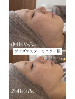 パタティパタタ(PatatiPatata)/プラズマスターで小顔が!