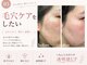 コモレビ(komorebi)の写真/【毛穴の黒ずみ・開き毛穴】フェイシャルワックスで透明感のある素肌へ|顔脱毛・毛穴