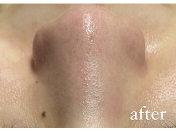 リリーブー 池袋(Lilyboo)/毛穴洗浄ハイドラフェイシャル