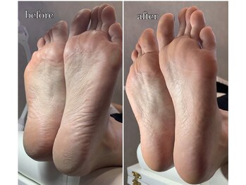 ファボリ(FAVORI)/足裏角質ケア