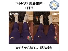 RKY/X脚・O脚改善