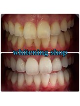 ホワイトニングショップ 高知店/ホワイトニング比較写真♪