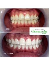 ホワイトニングサロン 名古屋駅店/【ホワイトニング施術例】