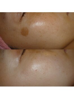 ドゥクス 難波店(Dux)/シミケア