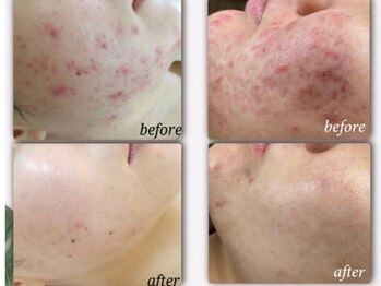 ベルドア(Bell Door)/ハーバルピーリング