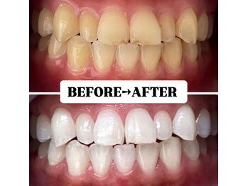 ホワイトニングサロン 豊中/Before&After美白ホワイトニング