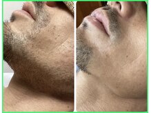 クリア 尾張旭店(Clear)/【Clear脱毛ビフォーアフター】