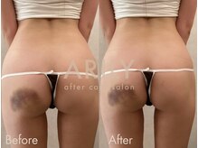 アリリィ(ARILY)/ダウンタイムケア/表参道/外苑前