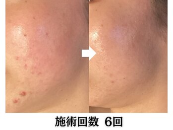 ハーブピーリング&毛穴洗浄専門店 肌REVO 高田馬場店[ニキビ/毛穴/たるみ/美白/シミ]/ハーブピーリング/ニキビケア