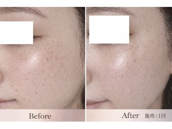 ビナシス(BINASHISU)の写真/【シミ・しわ改善＆予防】4月新登場！IPL光フェイシャルで影のないハリツヤ透明肌へ◎