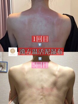フェアリー 小松店/NEW!漢方温活泥湿布でデトックス