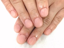 深爪矯正 施術後１