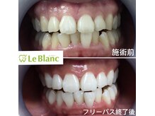 ルブラン 奈良店(Le Blanc)/白くするならフリーパス