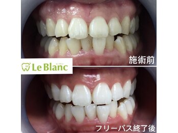 ルブラン 奈良店(Le Blanc)/白くするならフリーパス